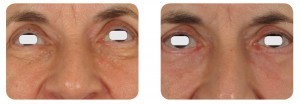 (Left) Baseline: A 64-year old female patient, skin type II. Presents dermatochalsia and extensive laxity of the lower lid in addition to syringomas on the lower lid, extending from the tear trough area to the lid margin. (Right) Postoperative Results: 8 weeks post one session. A transcutaneous skin pinch was planned to excise the excess skin, along with a concurrent C02 ablative laser resurfacing of each syringoma. A linear skin flap was oriented and raised along the subciliary line, approximately 4 mm from the lid margin. Approximately 2.5 mm of skin overlying the muscle was excised. The flap was closed with a subcuticular running non-absorbable suture. Following, syringoma lesions were treated as described in the Syringoma section.