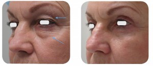(Left) Baseline: A 61-year old female patient, skin type III. Presents symmetric and bilateral dermatochalasia on the upper lids. Pronounced static creases and lines on the lower lids, extending into the latera canthal area. (Right) Postoperative Results: 6 months post one session. The entire ellipse of skin was elevated and incised with laser. A thin strip of orbicularis oculi muscle was excised in order to expose the orbital septum. The defect in the orbital septum was identified, and herniated orbital fat was exposed. The abnormally protruding positions in the medial with laser and the stalk meticulously cauterized with laser.  Afterwards, a single pass of the AcuPulse™ AcuScan120™ in Combo mode was used to resurface the lower lid complex.