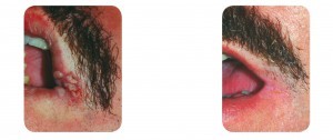 (Left) Baseline: A 35-year old male patient, skin type II. Presents verruca on the lip. (Right) Postoperative Results: 3 months post one session. 