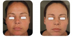 (Left) Baseline: 41-year old female patient, skin type II-III. Presents moderate photoaging, on the full face, with mild peri-oral rhytids. (Right) Postoperative Results: 4 months post one session of IPL and AcuPulse™ (M22™ IPL followed by AcuPulse™ Combo™ mode, using the AcuScan120™)