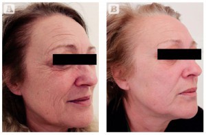 Figure 4 Photoageing of the face and neck in a 55-year-old Italian female, skin type II. (A) Baseline findings. (B) Excellent results 3 months after the second MFR treatment session, two passes per session, 2 weeks apart. 