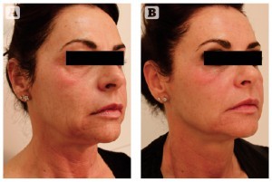 Figure 5 Photoageing of the face, neck, and décolleté in a 51-year-old Italian female, skin tye II-III. (A) Baseline findings. (B) Excellent results 3 months after the second MFR treatment session, two passes per session, 2 weeks apart.
