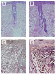 Figure 6 Histologic assessments of changes in collagen and elastin 2 weeks after eight sessions of 830 nm LED-LLLT monotherapy over 4 weeks. (A) Haematoxylin and eosin staining showing the condition of collagen at baseline. (B) 2 weeks post final treatment. A significant increase is seen in the amount and quality of collagen, with a very well-oriented Grenz layer, a thicker and more cellular epidermis, and well-organised stratum corneum. (C) Verhoeff-van Giesen stain showing the condition of the elastic fibres at baseline. (D) Findings 2 weeks after the final treatment. A significant increase in the amount and quality of elastic fibres is noted at all depths in the dermis, a thicker epidermis and well-formed stratum corneum. All at original magnification X 200. 