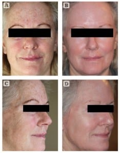 Figure 2 Photoageing, solar elastosis, and ephilides. Patient shown (A, C) before and (B, D) after treatment for 12 weeks with 0.65% retinol (ZO Retamax™)