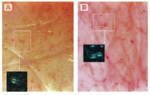 Figure 2 Treatment results viewed using the videocapillaroscopy optical probe. (A) Lack of microcirculation in the ischaemic area pre-treatment. (B) Post-treatment, observable microcirculation.