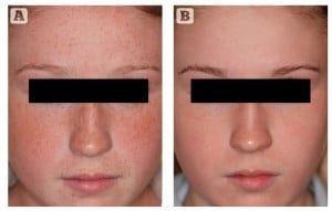 Figure 3 Ephilides, and familial pseudocutis laxa. Patient shown (A) before and (B) after treatment for 6 weeks with 1% retinol (ZO Brightenex™)