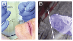 Figure 1 (A) The blunt tip microcannula, (B) TSK by Air-Tite microcannula with port at end of tapered blunt end tip