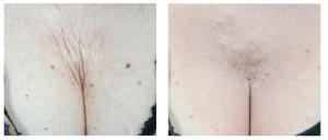 Figure 10 (A) Before and (B) after chrinkle treatment using Juvederm Ultra Plus and Voluma with TSK by Air-Tite microcannula
