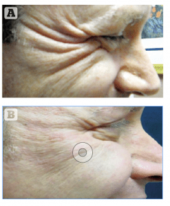 Figure 13 (A) Before and  (B) after Juvederm treatment of crow’s feet using TSK by Air-Tite microcannula