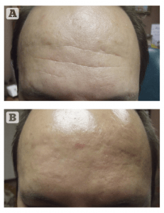 Figure 14 (A) before and (B) after Frontalis Juvederm treatment using TSK by Air-Tite Microcannula