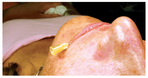 Figure 2 Pilot needle placement for Juvederm®  lip enhancement