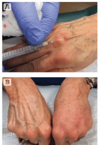 Figure 6 (A) Radiesse injection, with TSK by Air-Tite microcannula, glides over vein. (B) Left hand immediately after Radiesse injection using TSK by Air-Tite microcannula