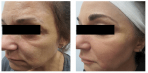 Figure 8 (A) Before and (B) after cheek treatment using Juvederm Voluma with TSK by Air-Tite microcannula