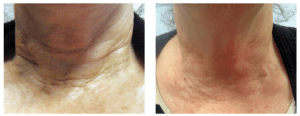 Figure 9 (A) Before and (B) after neck treatment using Juvederm with Air-Tite Microcannula