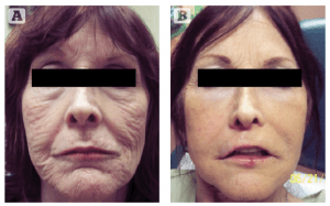 Figure 16 Non-surgical results with only Juvederm and Restylane cosmetic injections