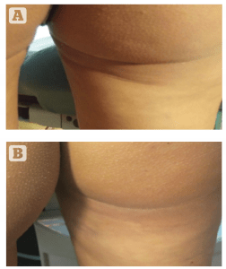 Figure 15 (A) Before and (B) after cosmetic filler using the long microcannula double cross-hatched fan technique for liposuction scar