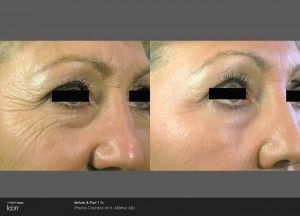 Skin Rejuvenation treatment : Before and After 