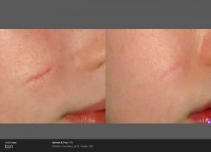 Surgical scar - before and after