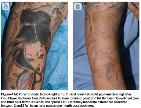 REMOVAL OF TATTOO BY 1064 AND 532nm QSWITCHED NdYAG LASER  Semantic  Scholar