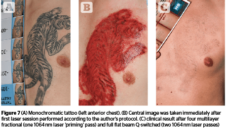 left Scar tissue after a tattoo removal with a nonQswitch laser   Download Scientific Diagram