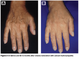 Hand Rejuvenation: Three-Step Combination Therapy | PRIME Journal