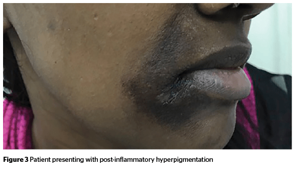 Hyperpigmentation on Black Skin