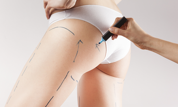 Revolutionary brand-new technology is offering a very real solution for cellulite