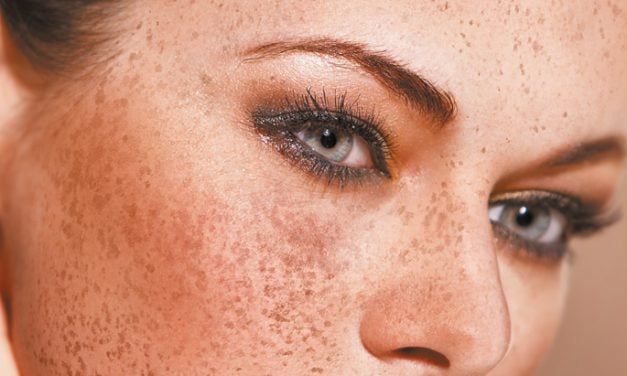 Treating Melasma Effectively Using a Controlled, Individual Bleach-Peel