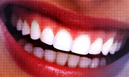 Plasma Exeresis – A Novel Approach to Treat Gummy Smile