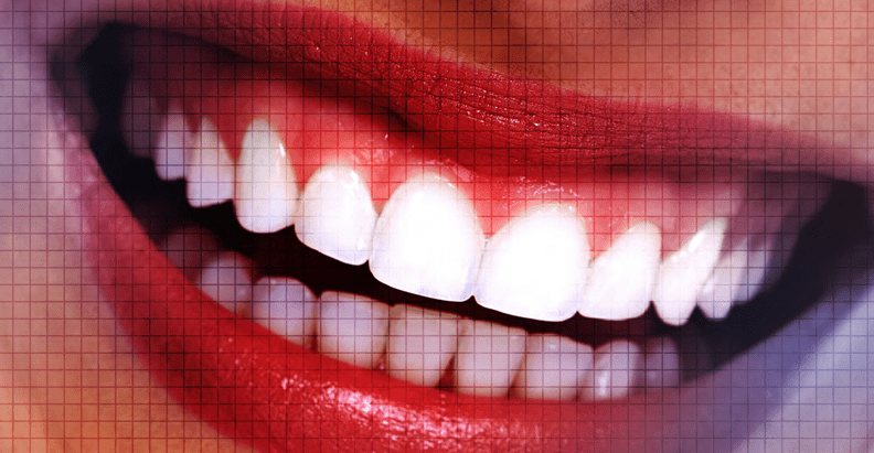 Plasma Exeresis – A Novel Approach to Treat Gummy Smile