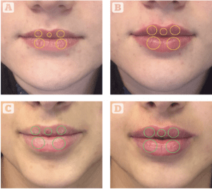 The non-surgical lip lift with tubercle shifts | PRIME Journal