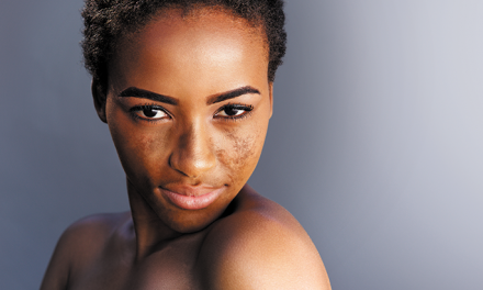 Cysteamine for Treating Hyperpigmentation