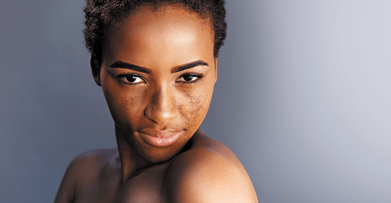 Cysteamine for Treating Hyperpigmentation