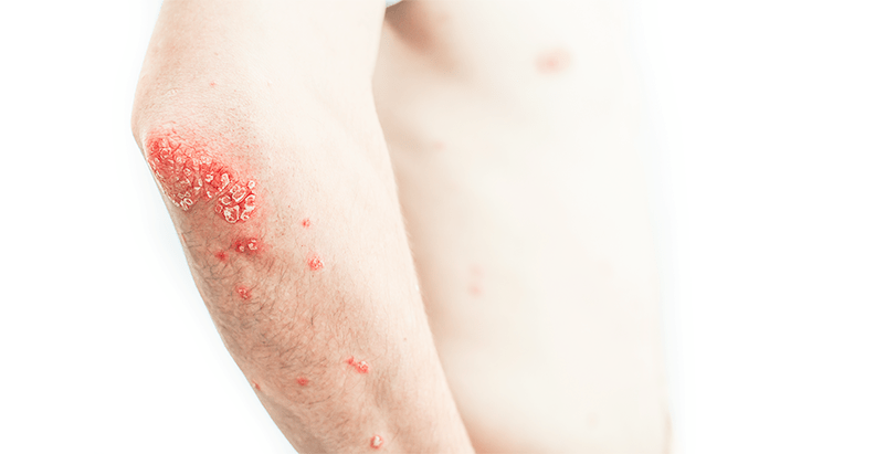 International Council Of Dermatologists Introduces New Method Of Determining Psoriasis Severity