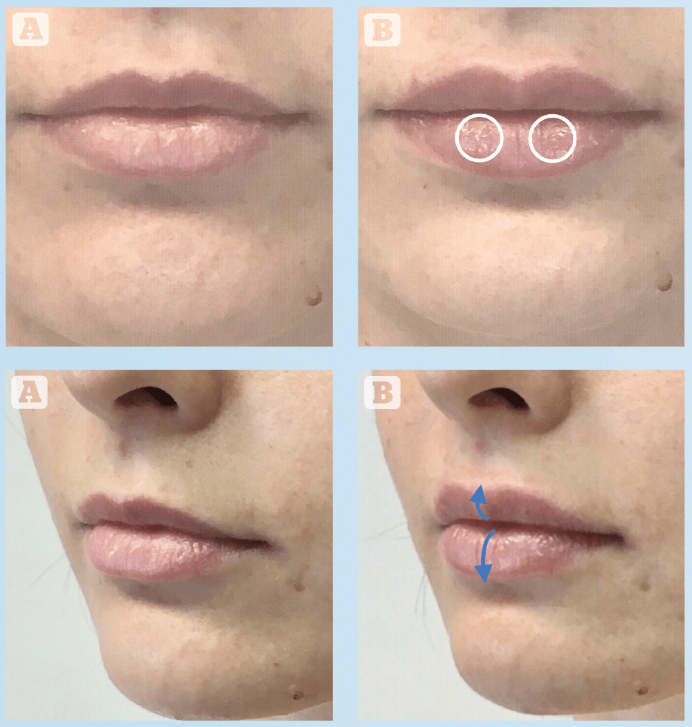 The Non-surgical Lip Lift (NLL) with tubercle shifts, H-Lines and H ...