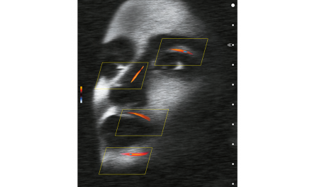 Use of Duplex Ultrasound in Facial Aesthetics