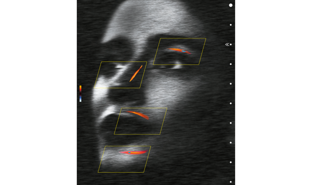 Use of Duplex Ultrasound in Facial Aesthetics