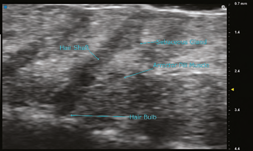 Ultra High Frequency Ultrasound