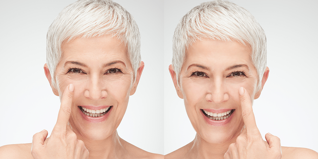 New, objective approach can help estimate the age after facelift surgery