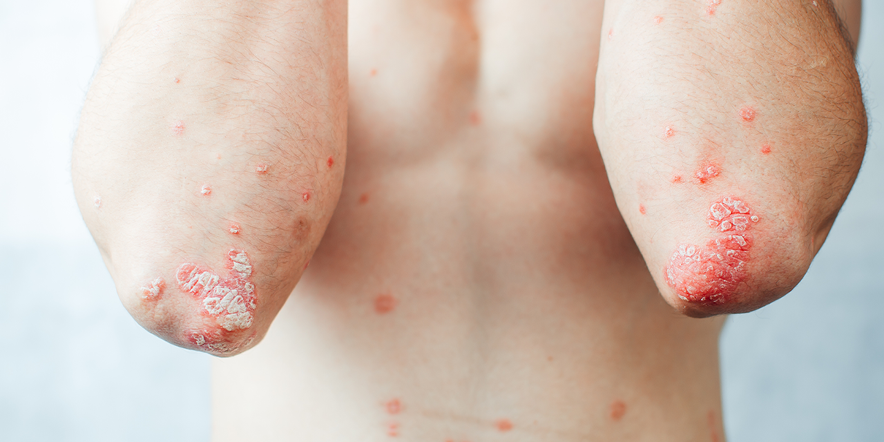 New evidence-based resources to guide treatment of plaque psoriasis