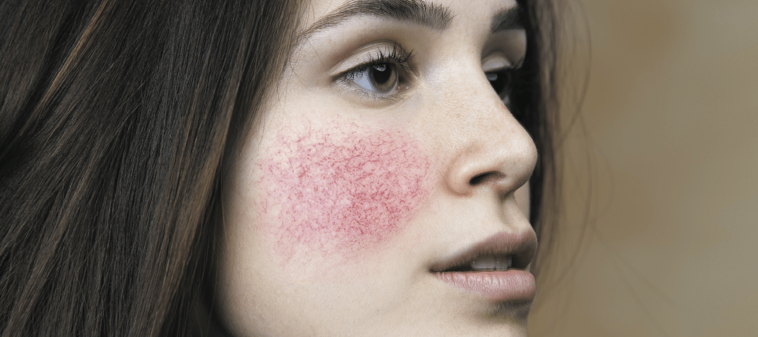 Rosacea and its systemic co-morbidities and associations