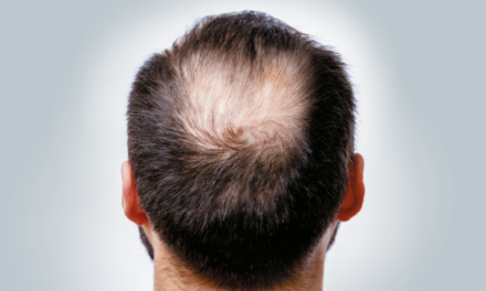 Growth Factors and Stem Cells to solve Hair Loss and Hair Thinning