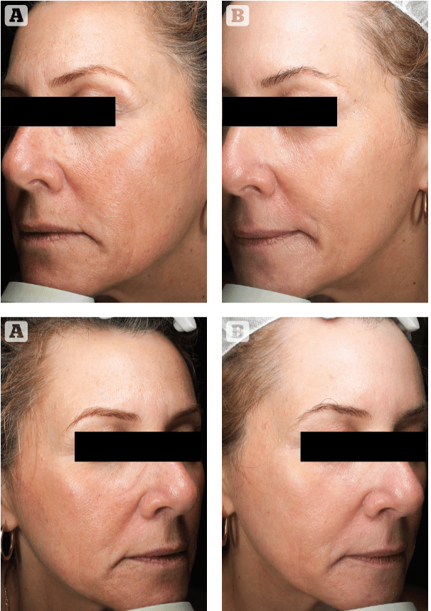 CO2 Laser Resurfacing Palo Alto, CA