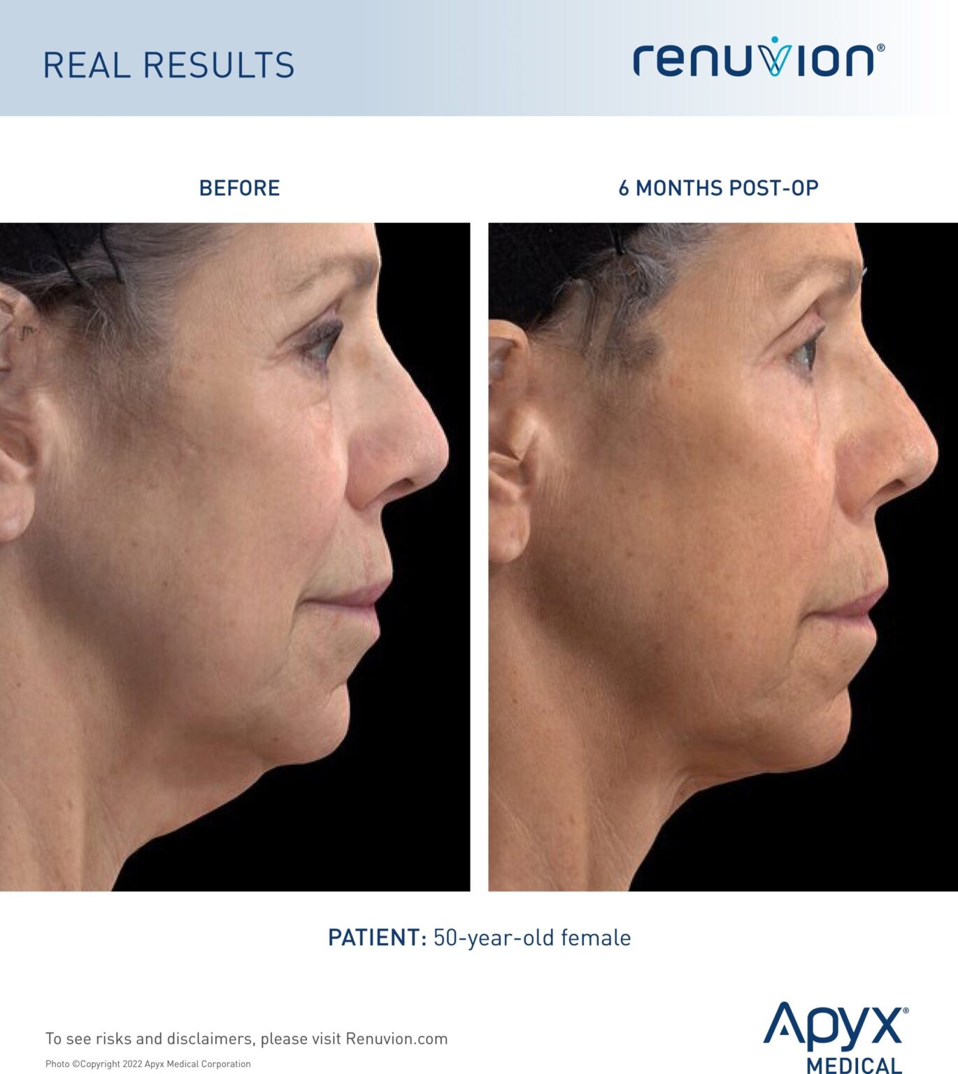 Renuvion® cleared by FDA for neck laxity procedures offering patients a