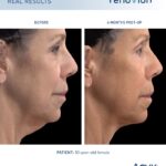 ￼Renuvion® cleared by FDA for neck laxity procedures offering patients a minimally invasive option to eliminate sagging neck