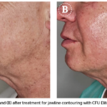 A non-invasive approach for jawline contouring