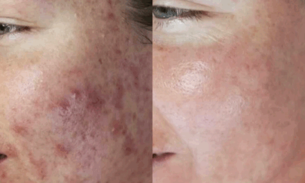 Light on Skin. Tough on Acne